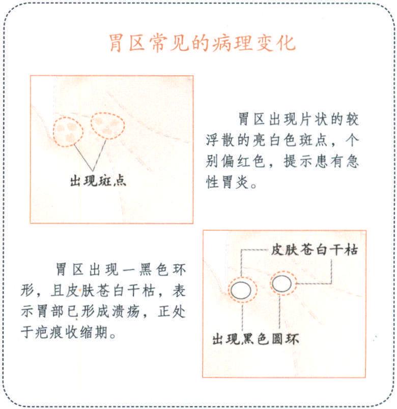 手掌上的胃區(qū)